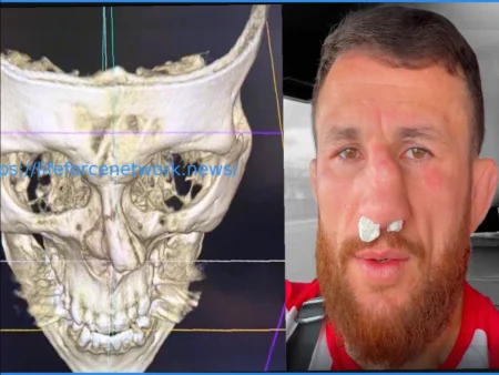 Мераб Двалишвили Отказывается от Операции на Носу, Несмотря на Тяжелую Травму, Готовясь к Реваншу с Петром Яном