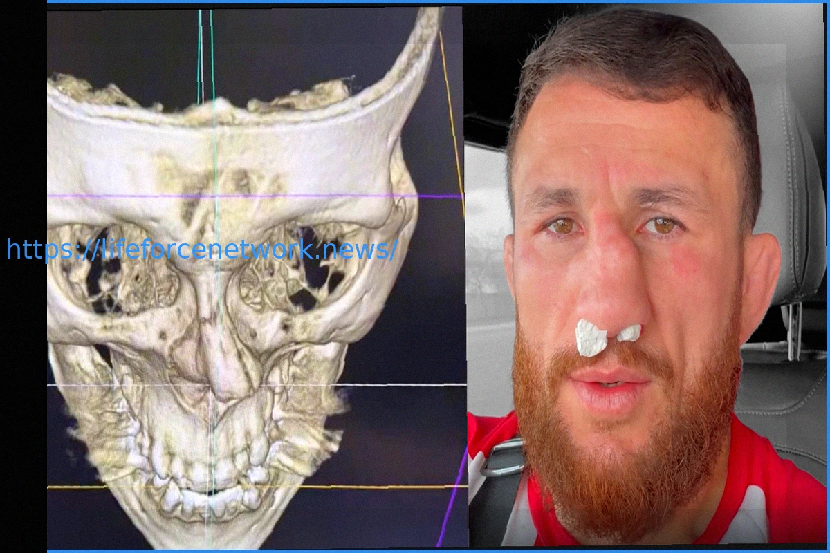 Preview Мераб Двалишвили Отказывается от Операции на Носу, Несмотря на Тяжелую Травму, Готовясь к Реваншу с Петром Яном