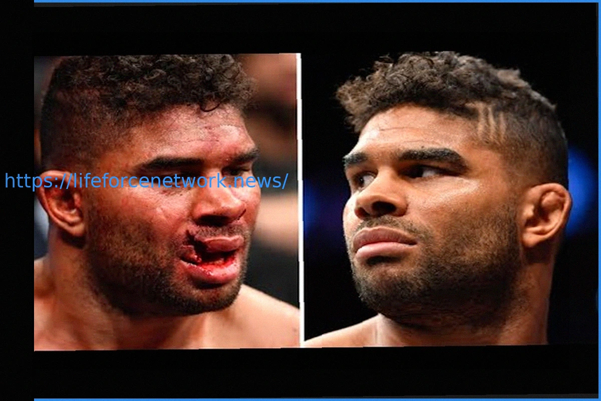 Preview UFC спортсменка показала шокирующее видео: дренаж извлечен из глаза после травмы